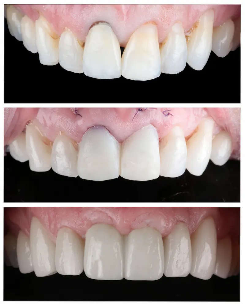 Colocación de implantes -Antes y después Colocación de implantes -Antes y después
