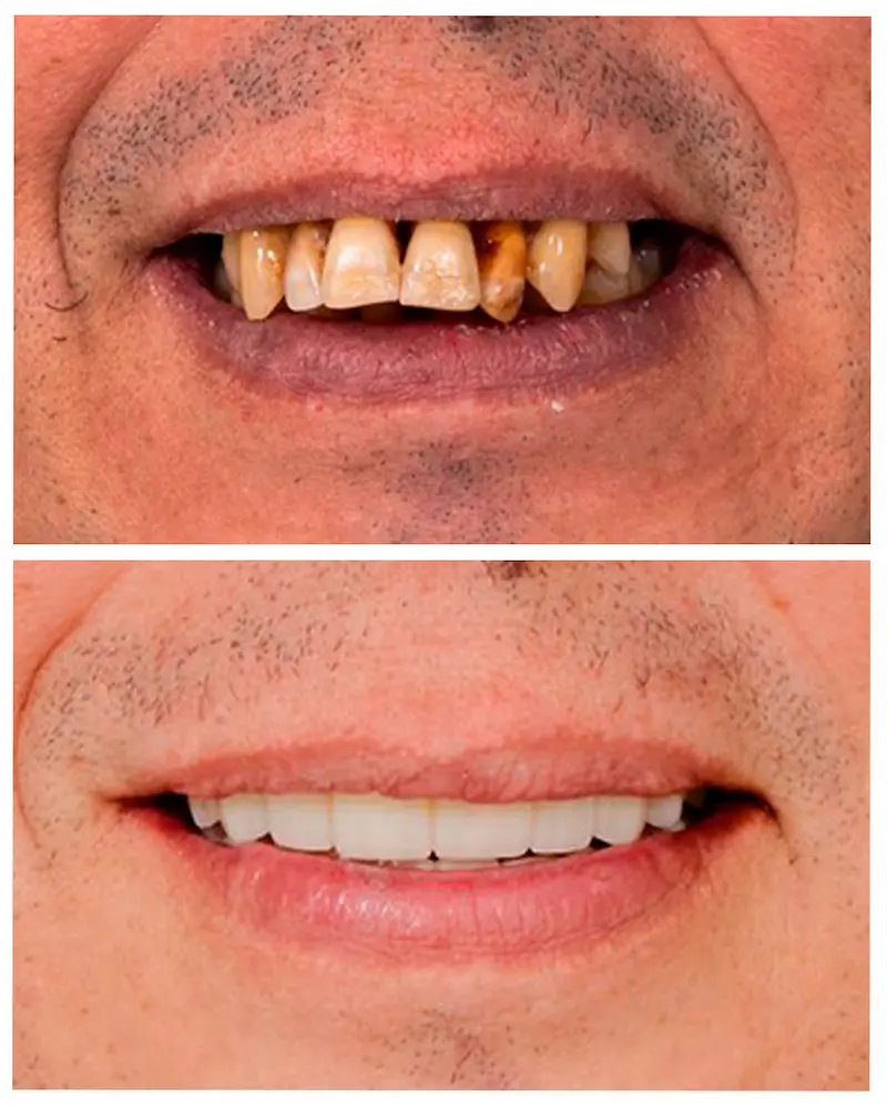 Antes y después, regeneración ósea Antes y después, regeneración ósea